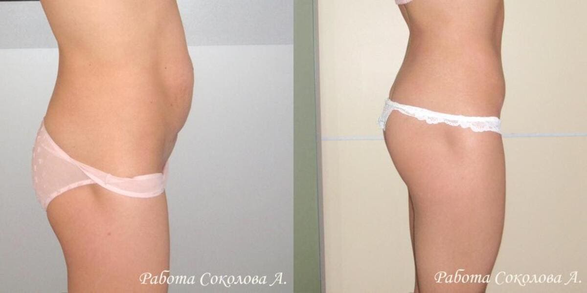 Абдоминопластика