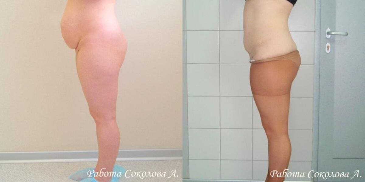 Липоксация