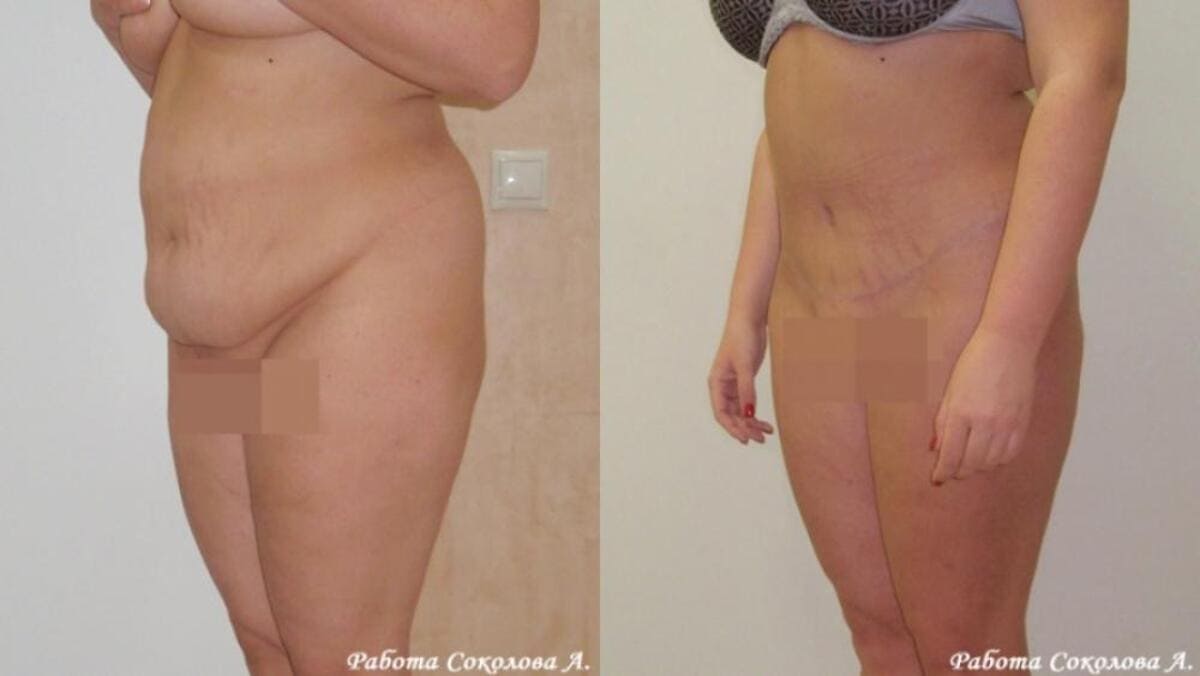 Абдоминопластика