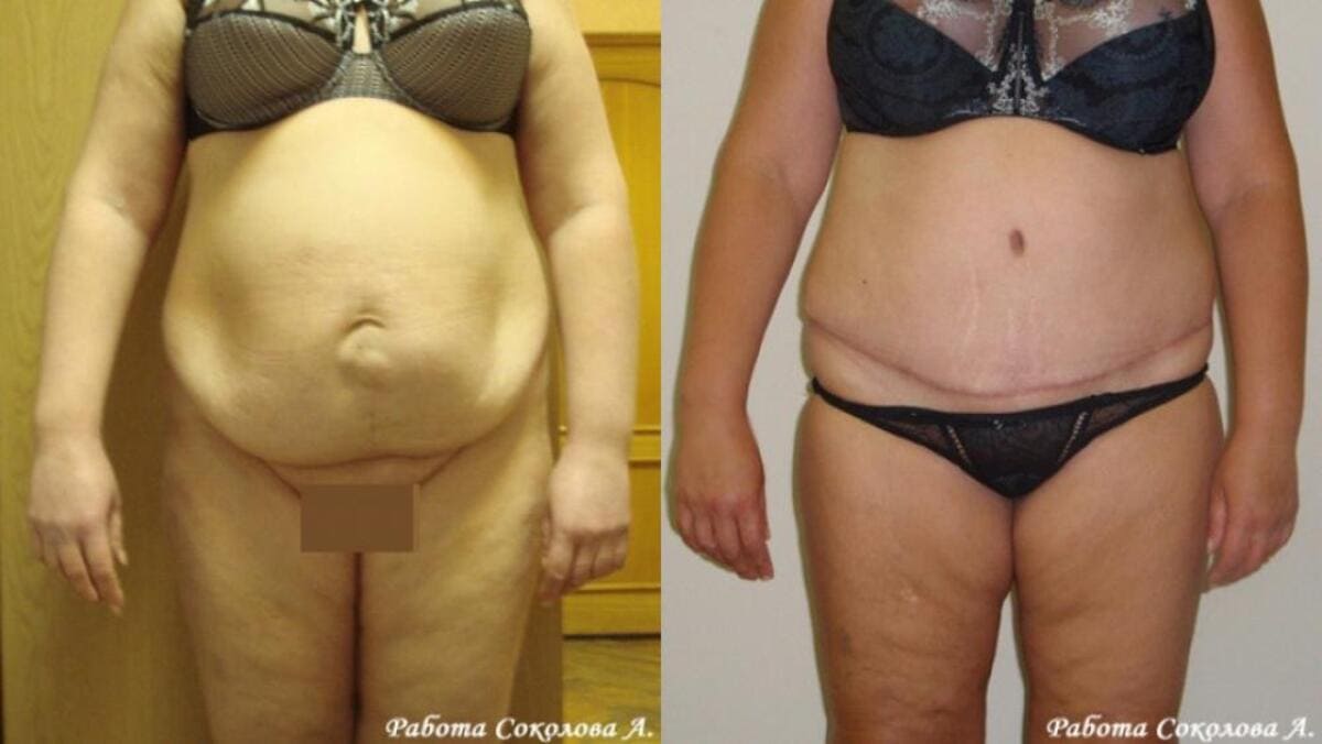 Абдоминопластика