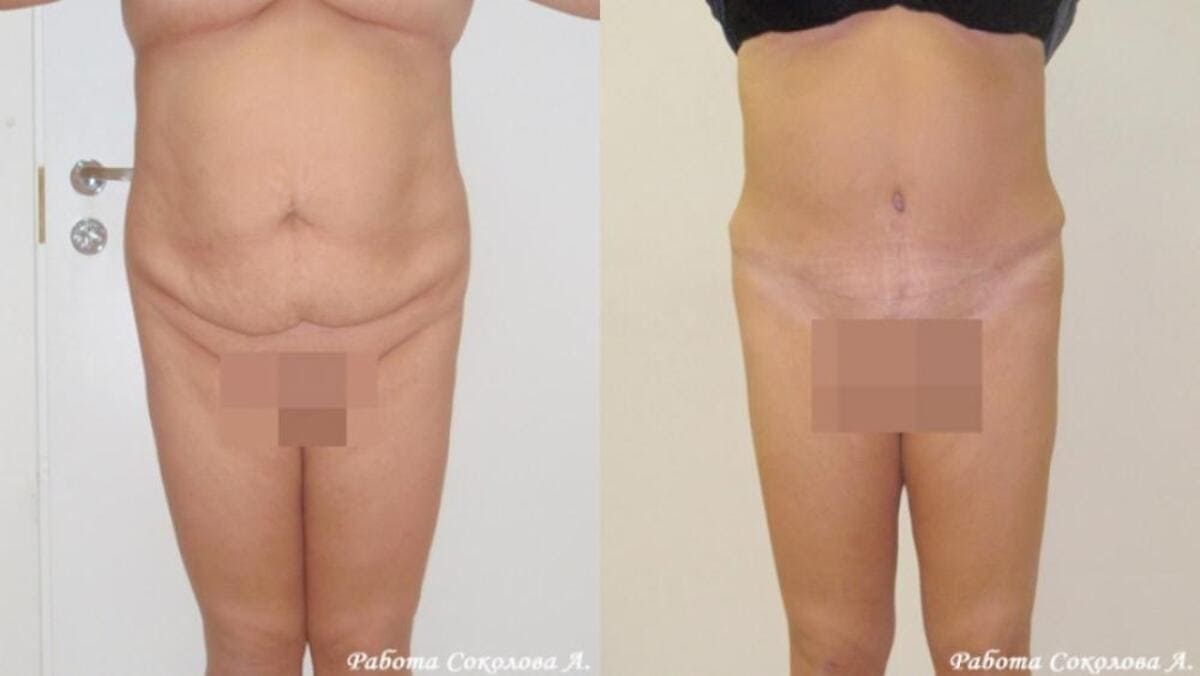 Абдоминопластика