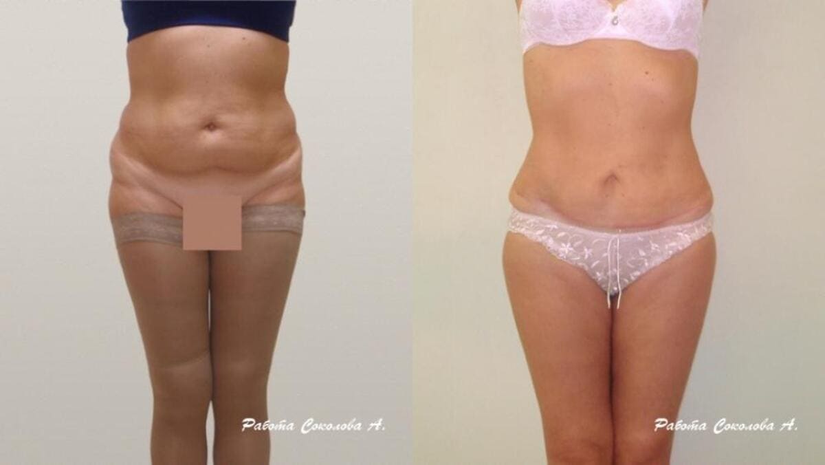 Абдоминопластика