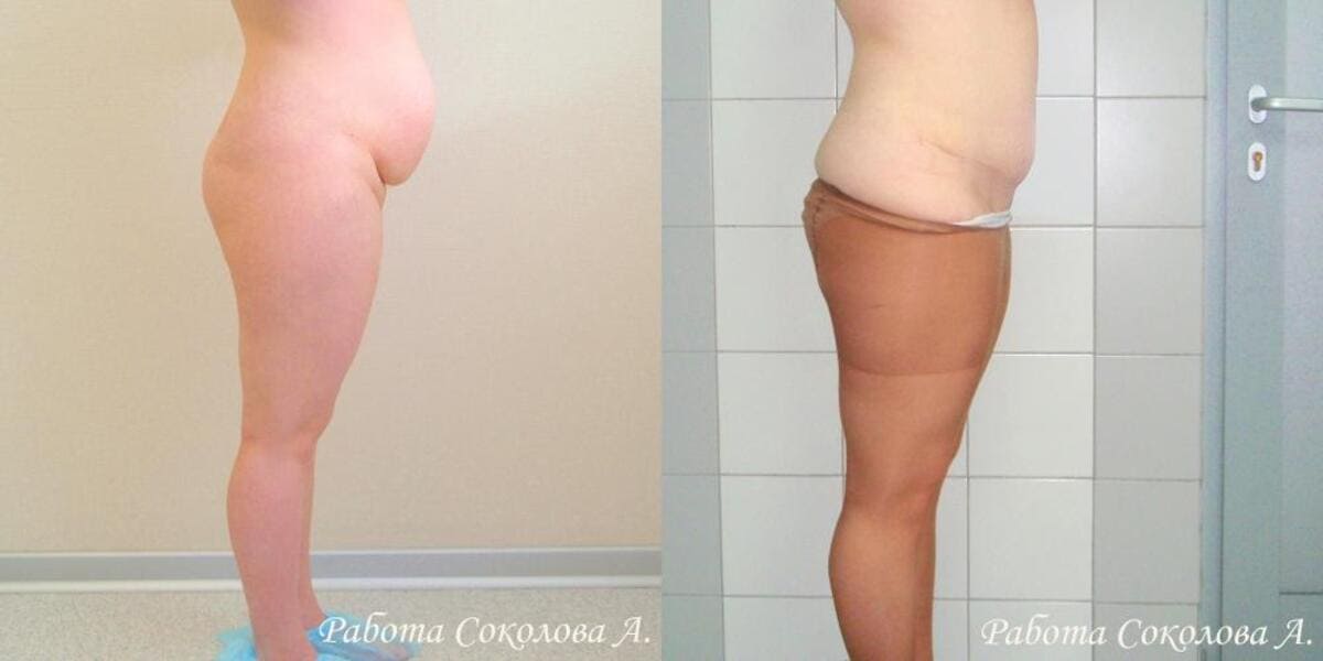 Абдоминопластика