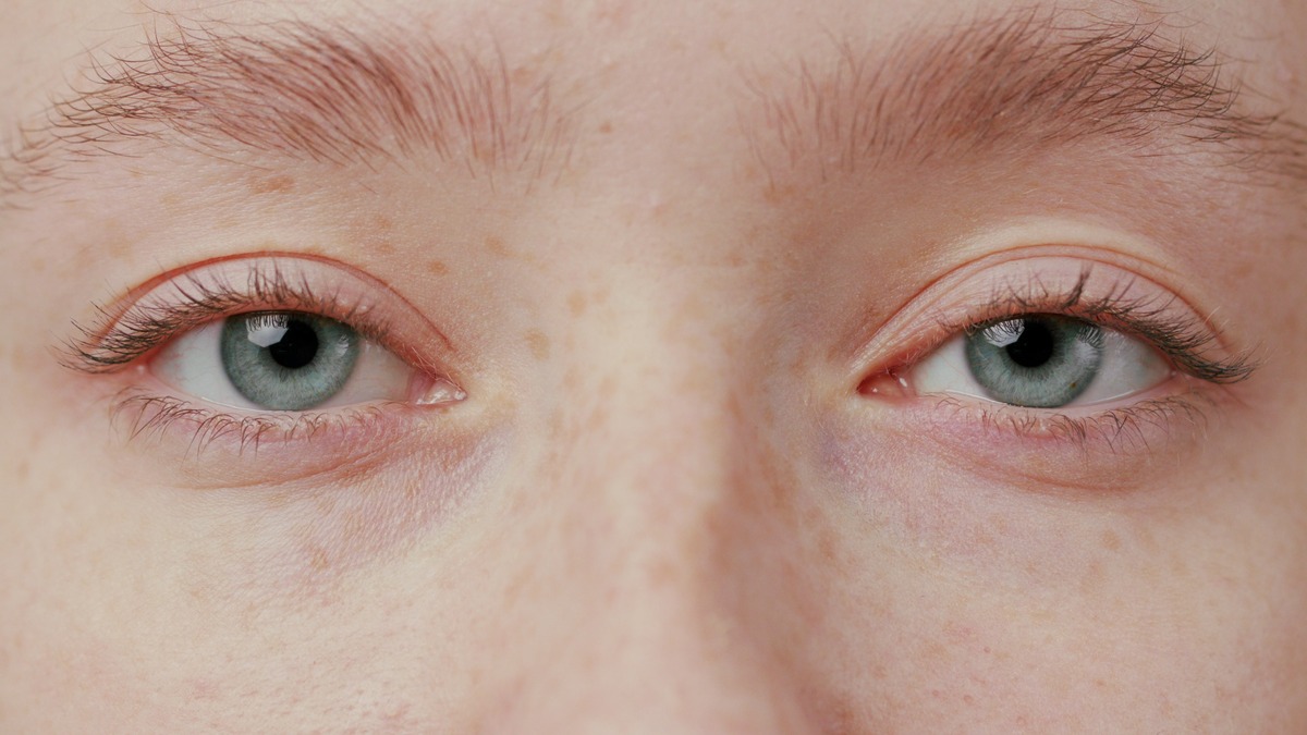 Бесшовная блефаропластика