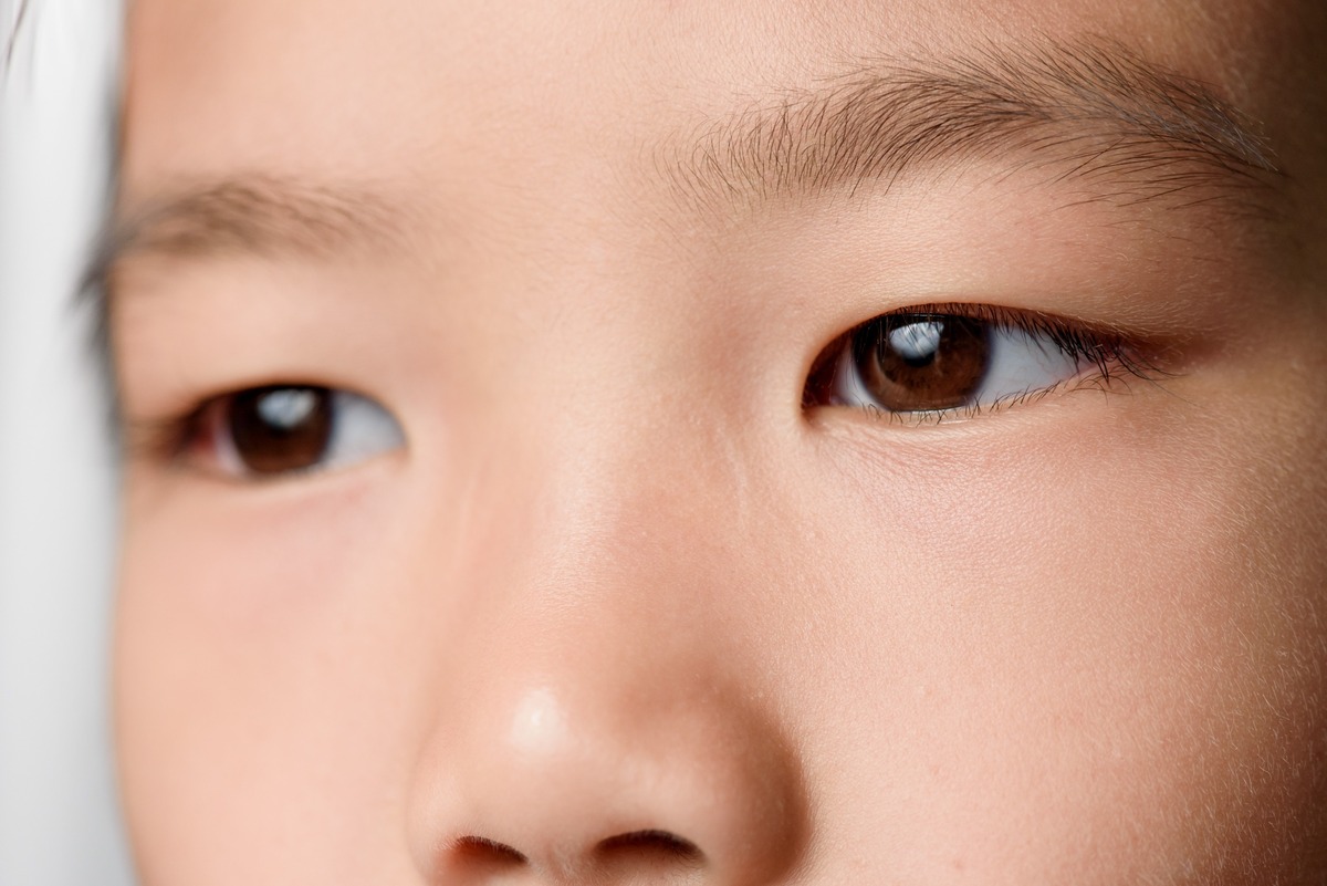 Блефаропластика азиатских глаз (сингапури)