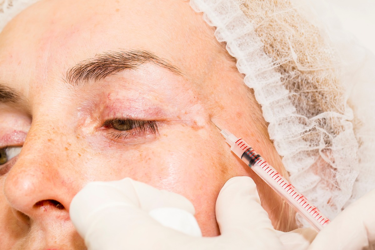 Ботокс после блефаропластики