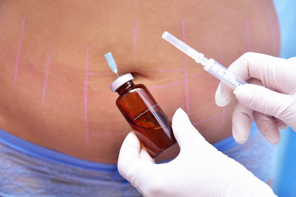 Инъекционная липосакция