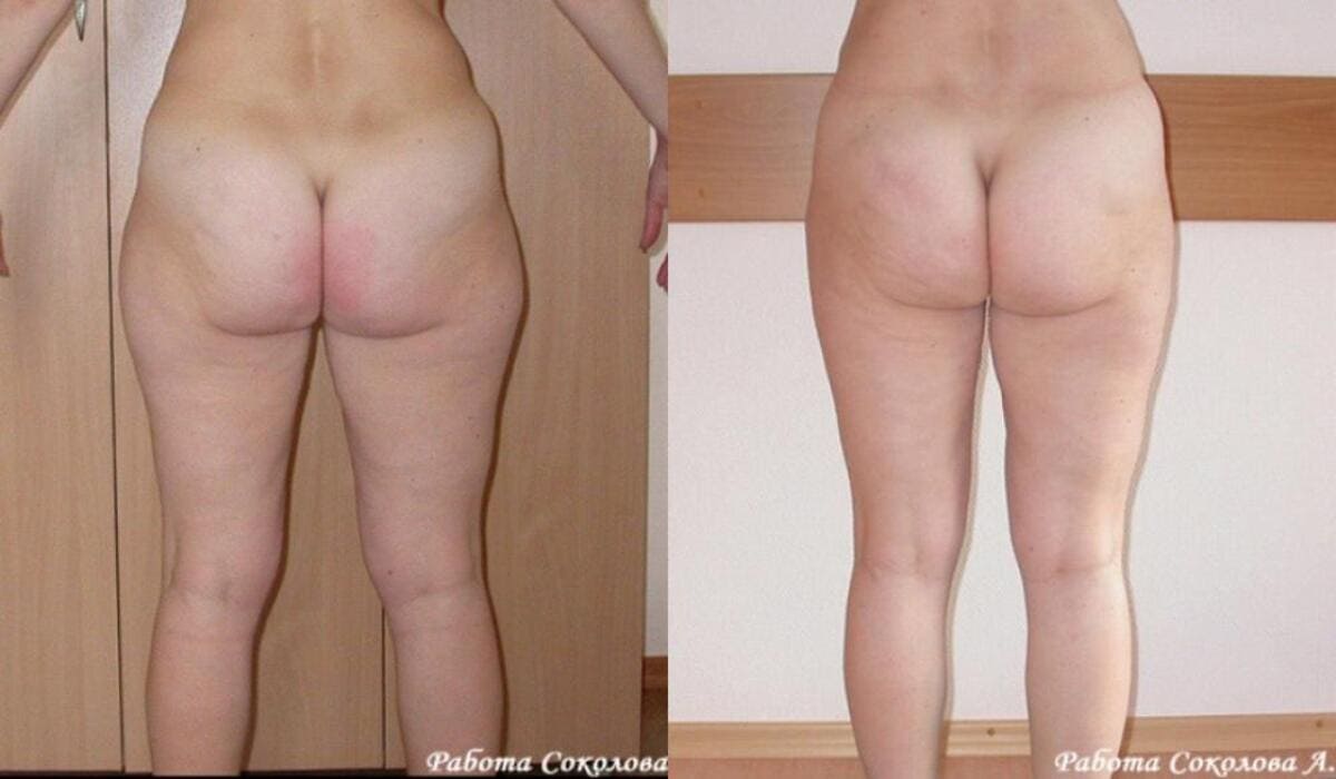 Липоксация