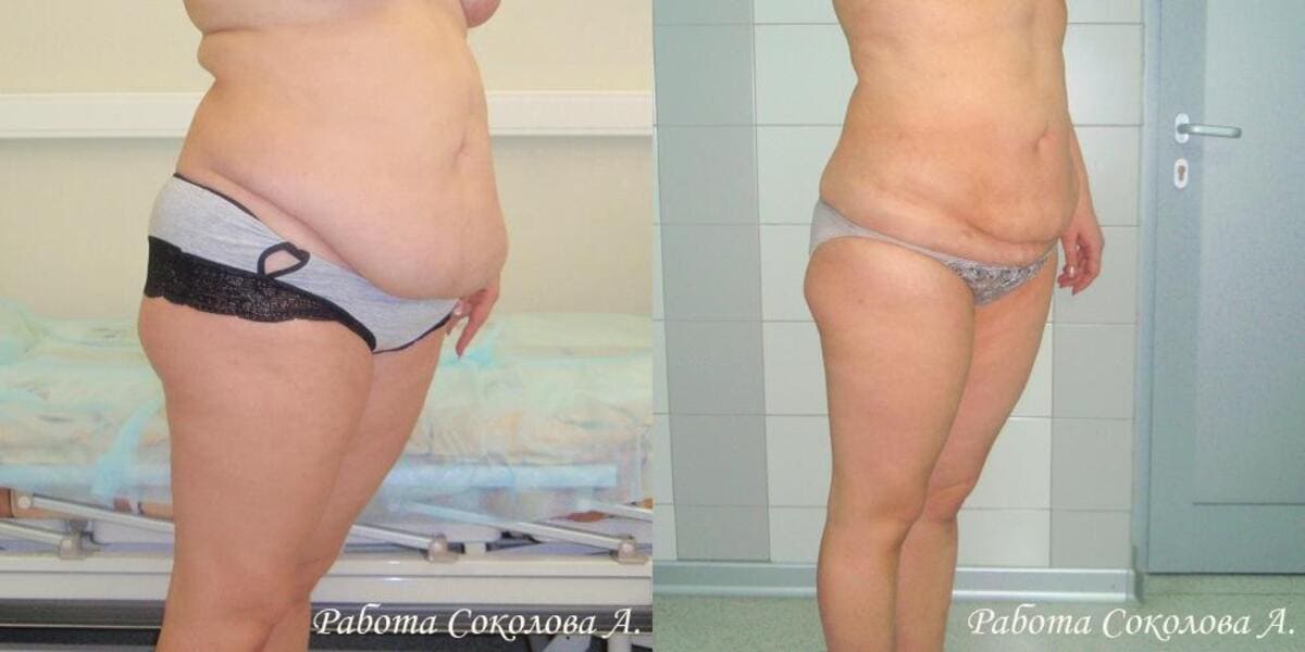 Липоксация