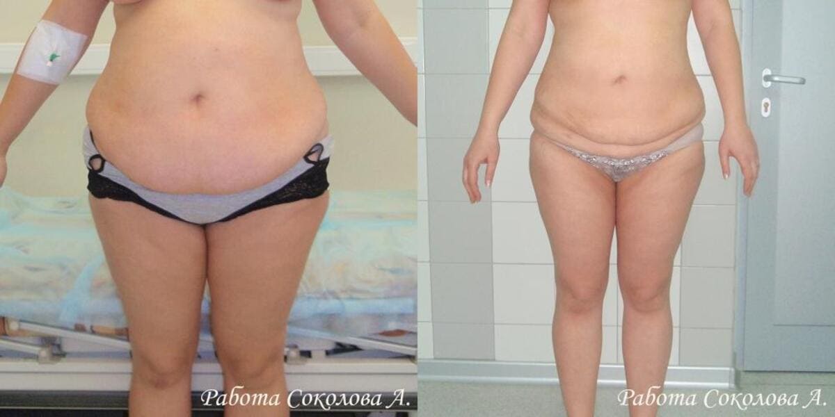 Методы уменьшения жира