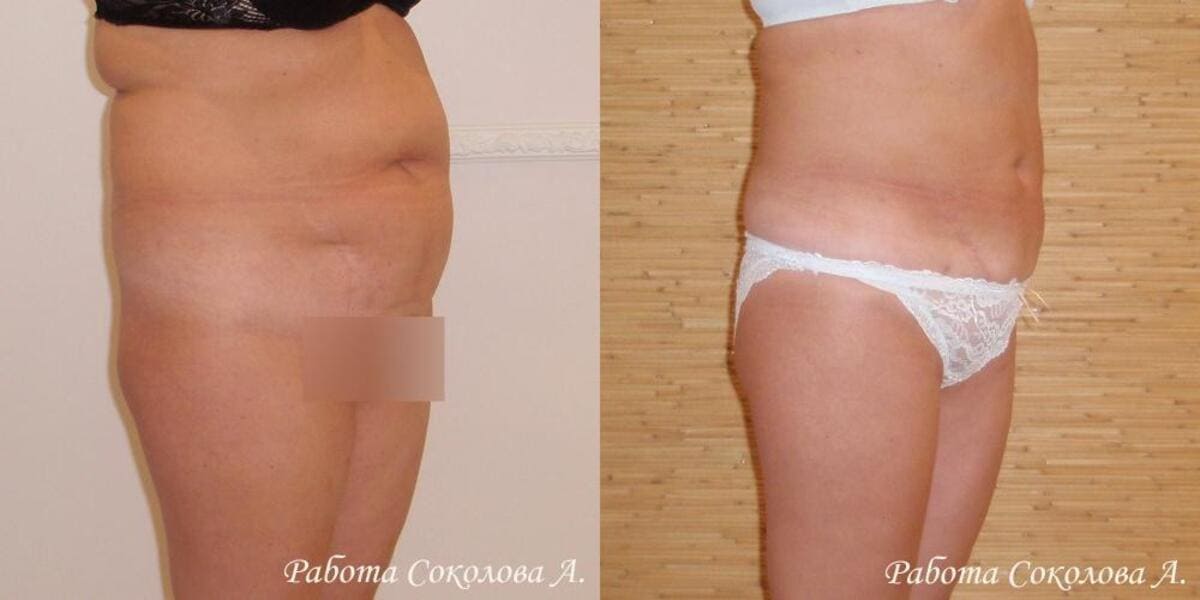 Методы уменьшения жира