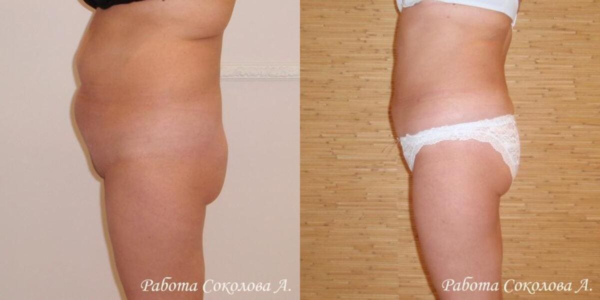 Криолипосакция