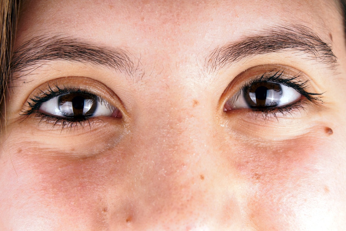 Круговая блефаропластика