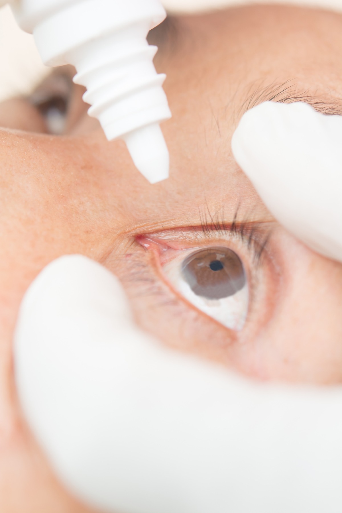 Круговая блефаропластика