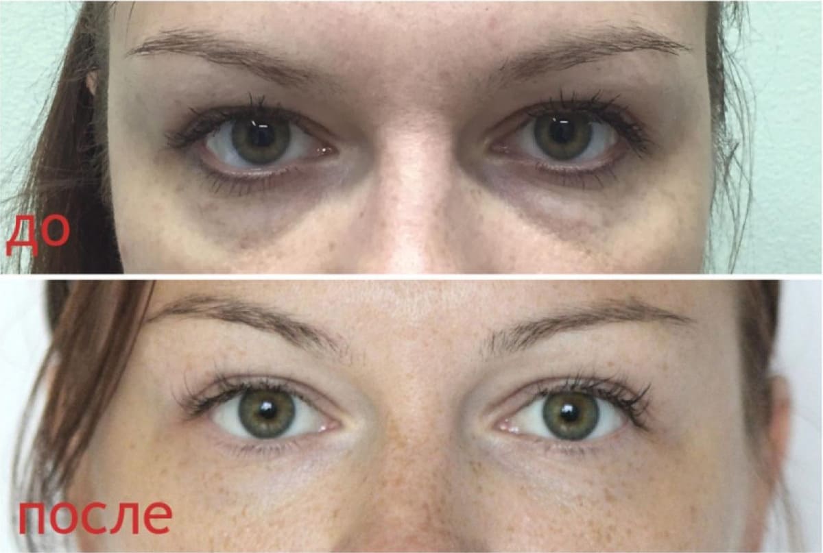 Липофилинг лица