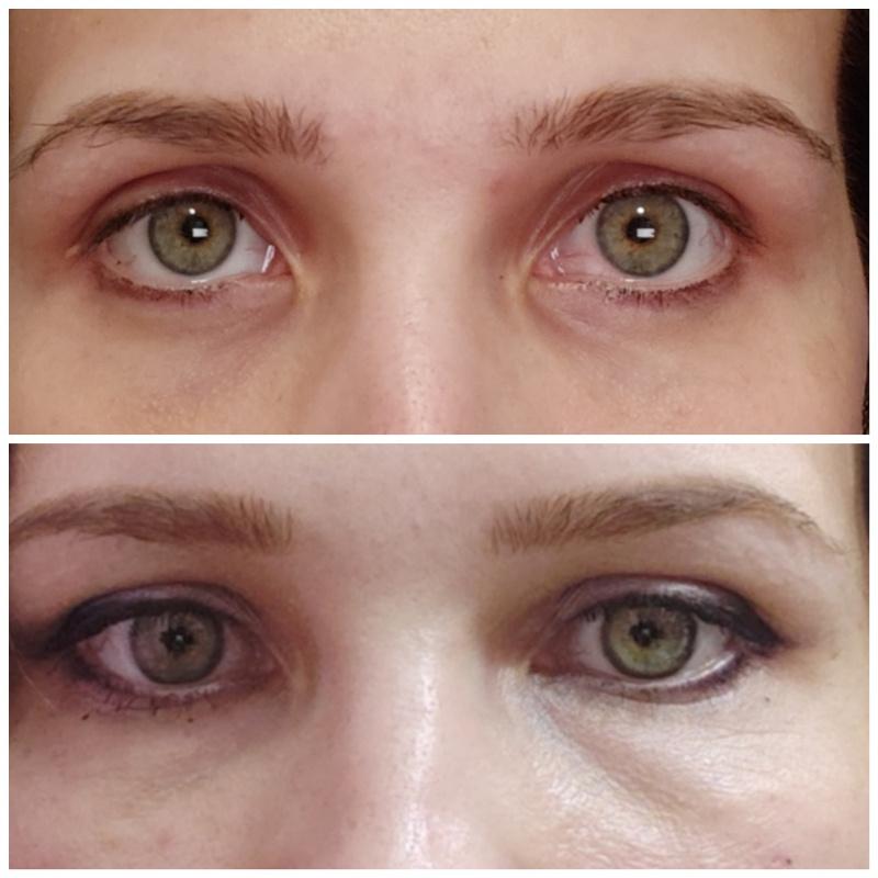 Липофилинг лица