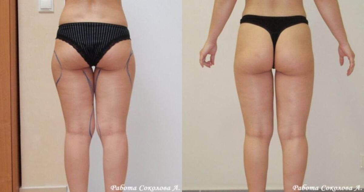 Липоксация