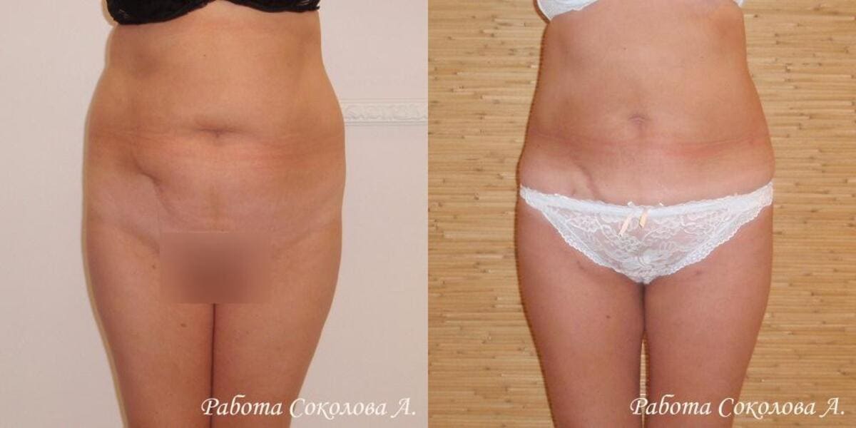 Липоксация