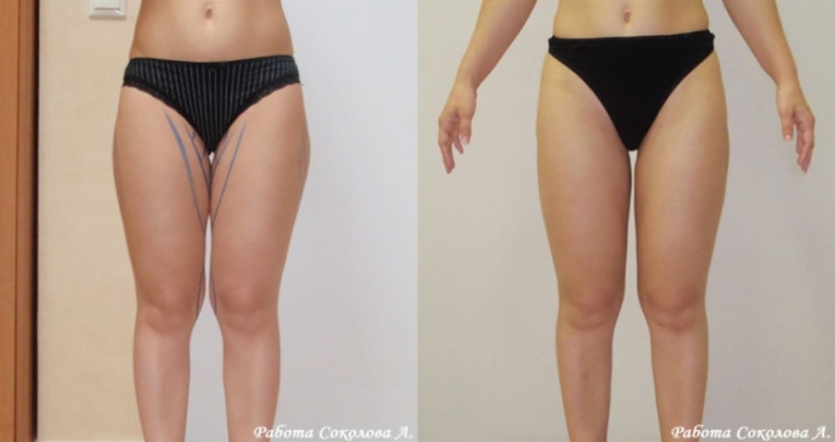 Липосакция