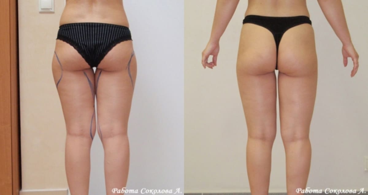 Липосакция