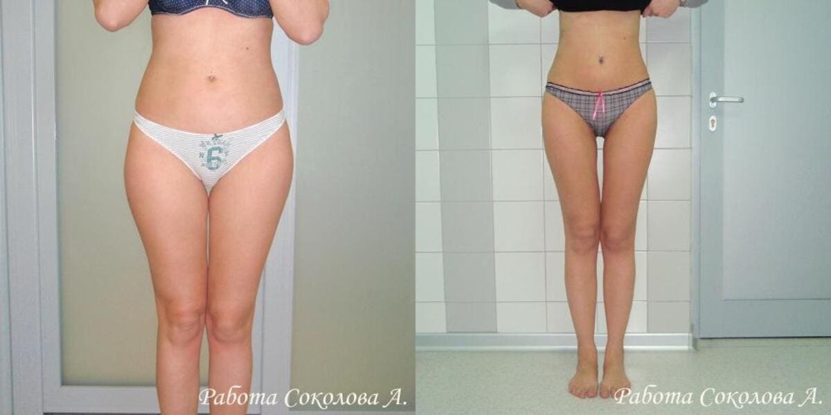 Липосакция холодной плазмой