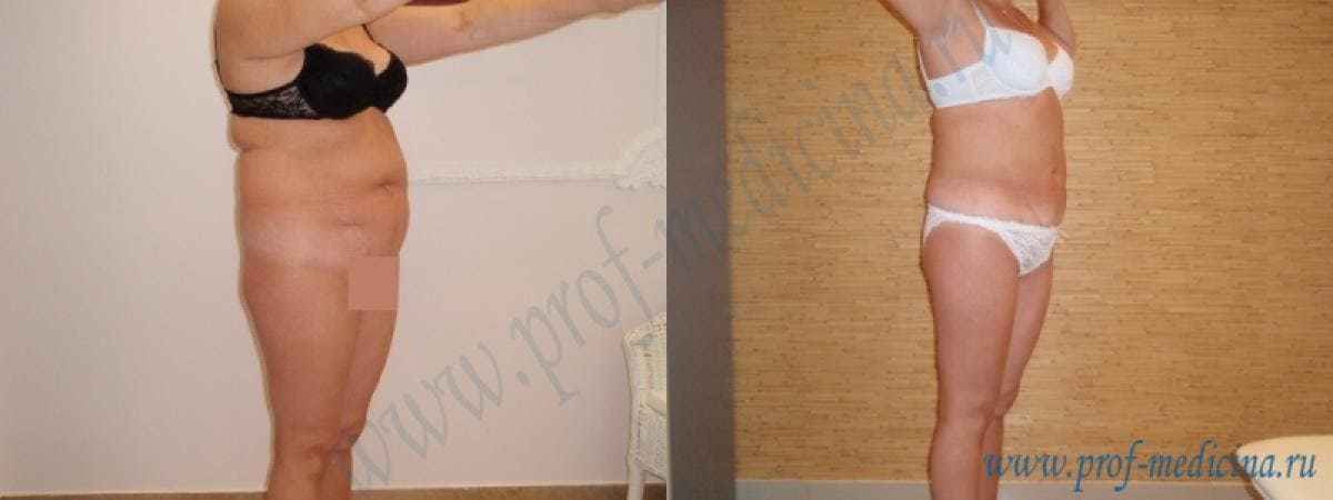 Липосакция холодной плазмой