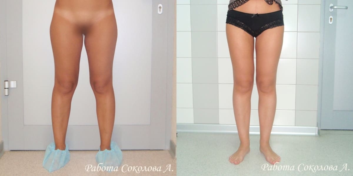 Липосакция