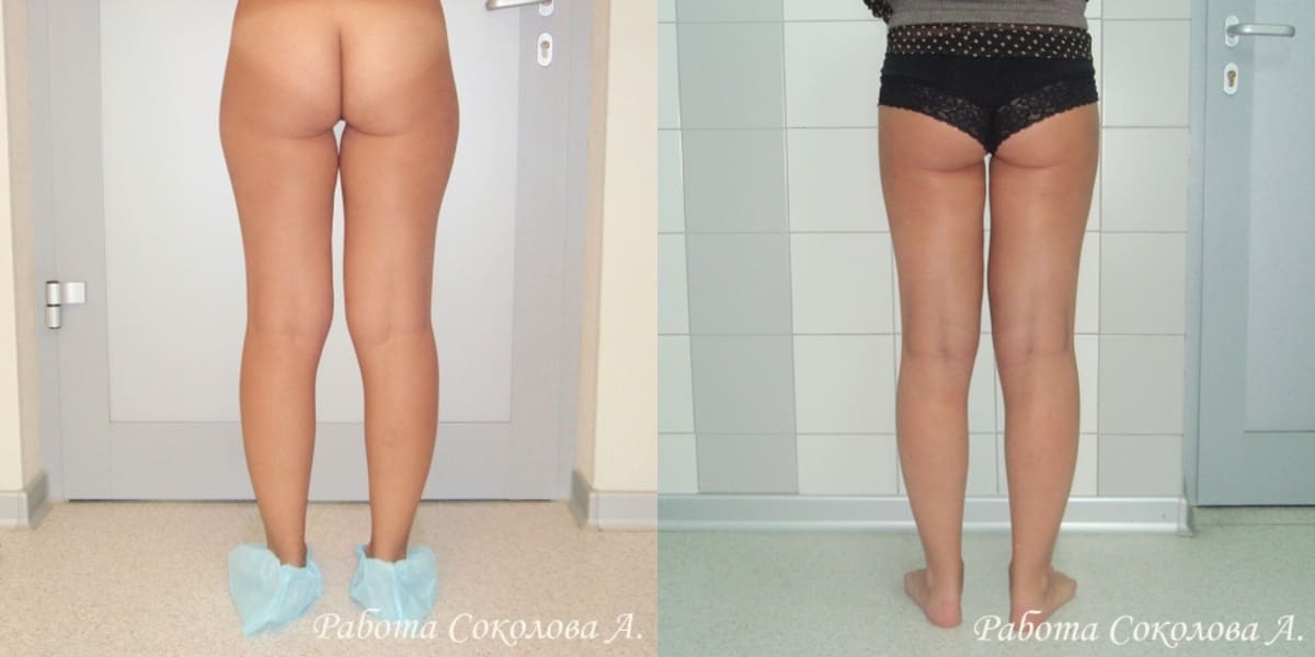 Липосакция