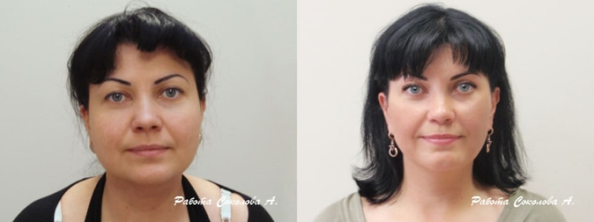 Липосакция