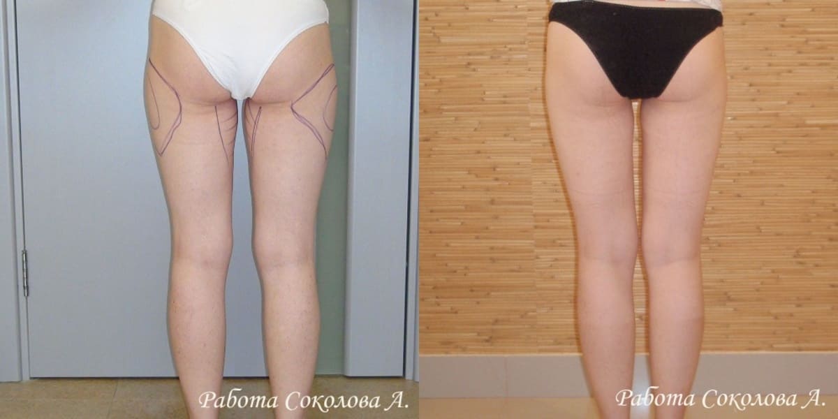 Липосакция