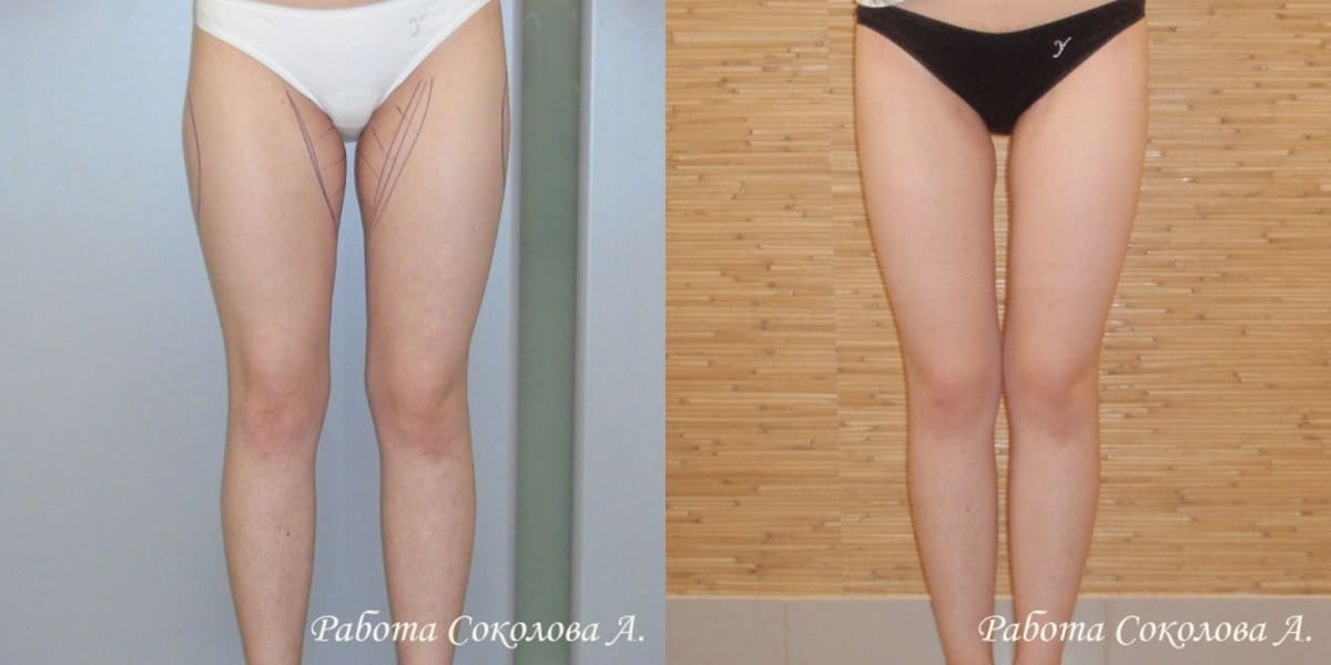 Липосакция