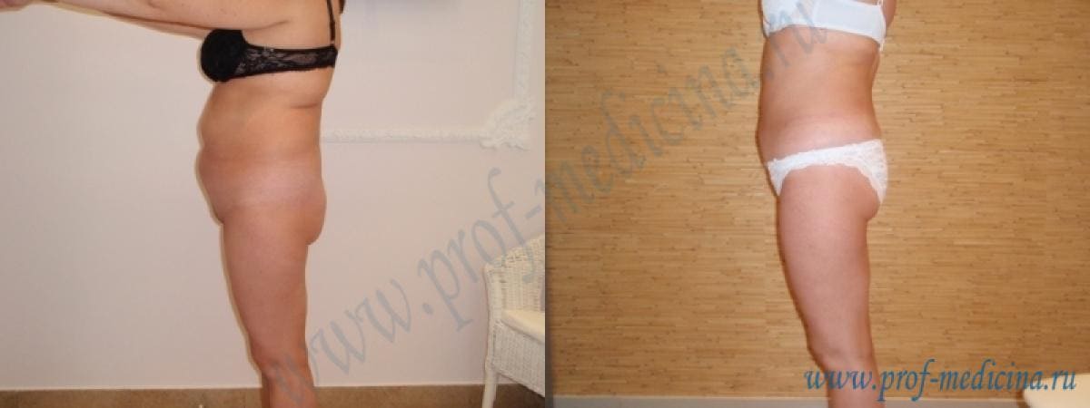 Липосакция VASER