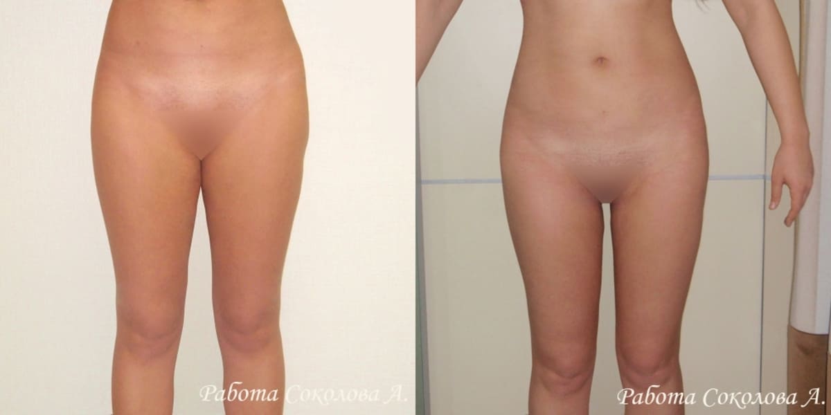 Липосакция