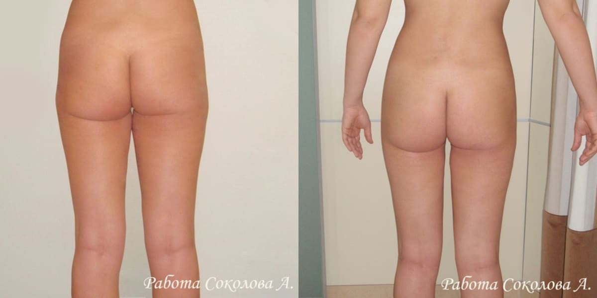 Липосакция