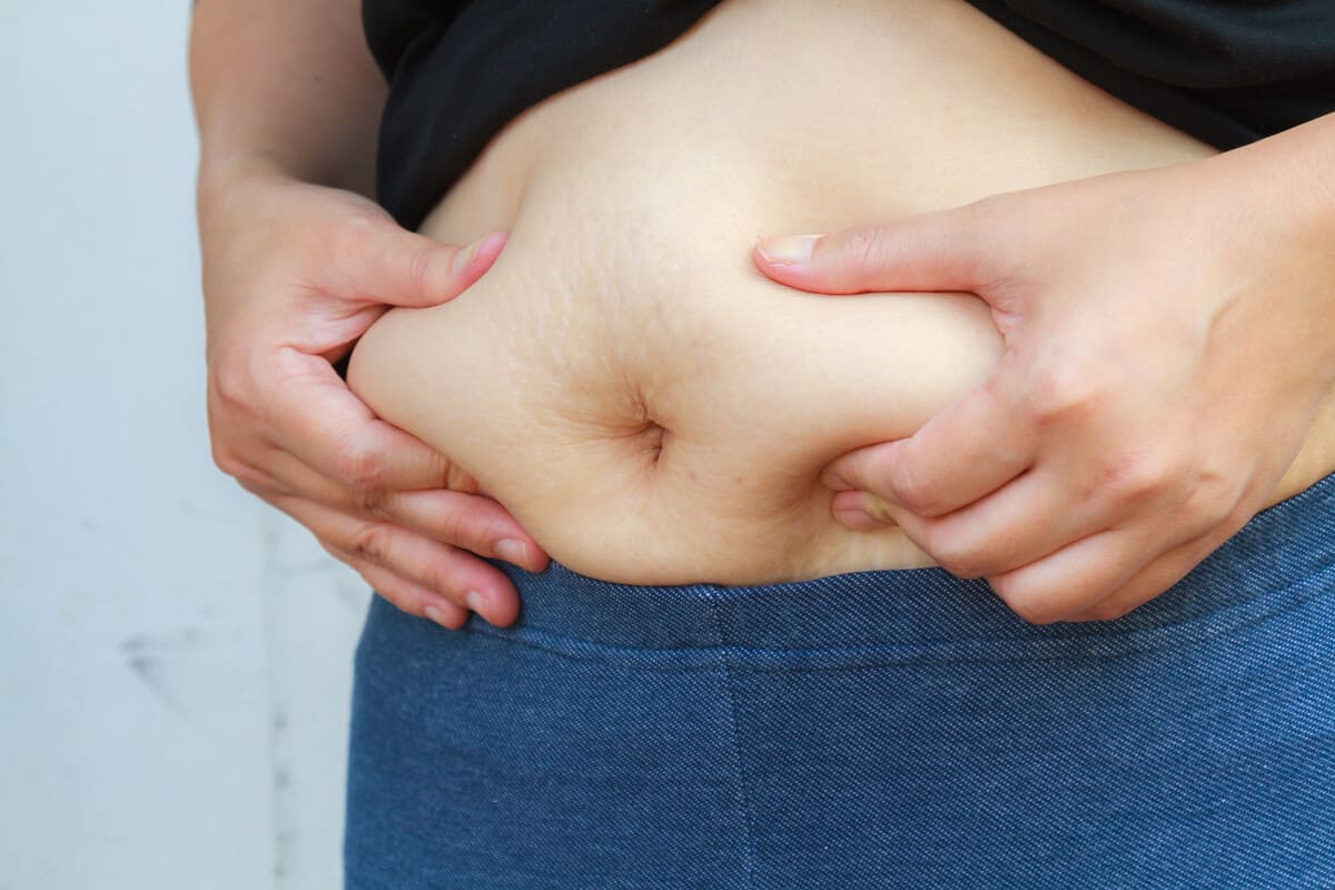 Липосакция