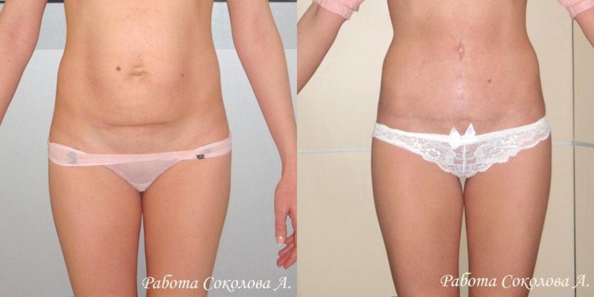 Абдоминопластика