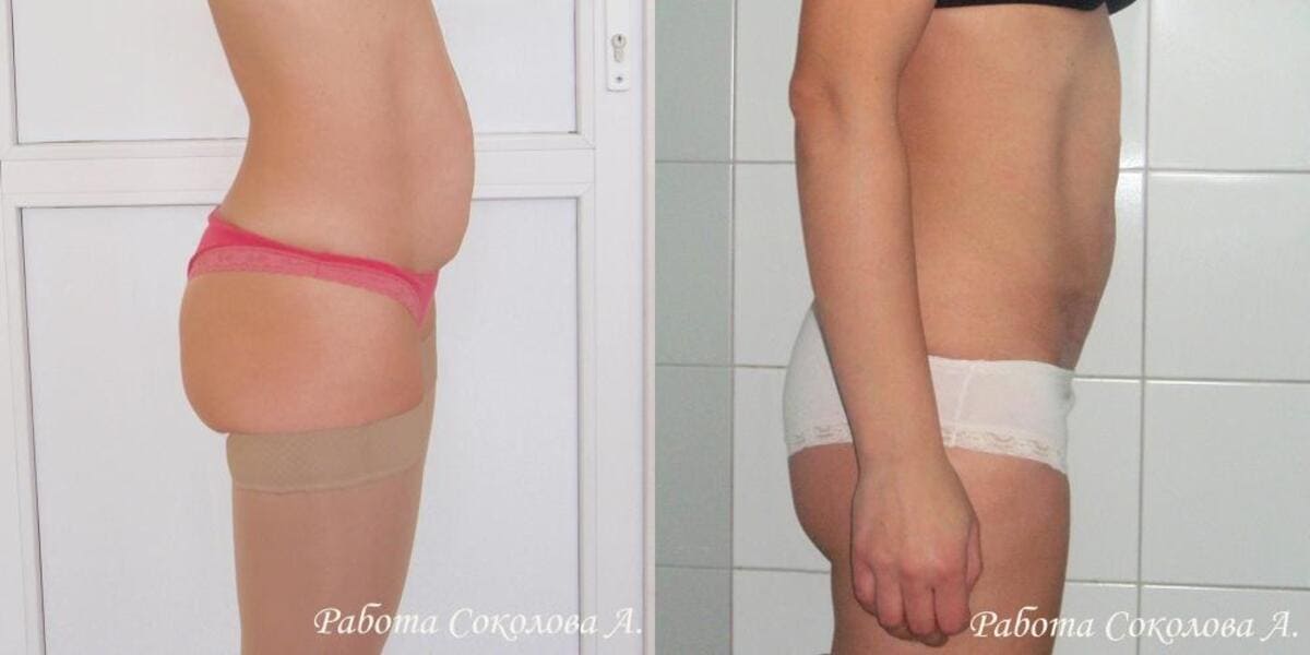 Абдоминопластика