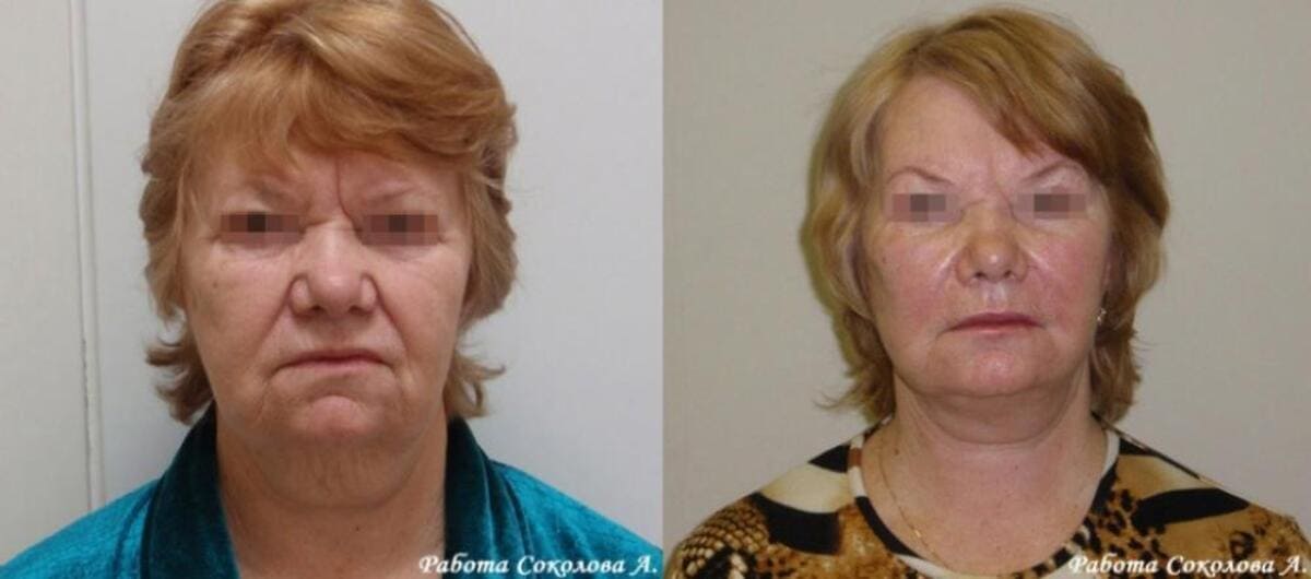 Подтяжка лица