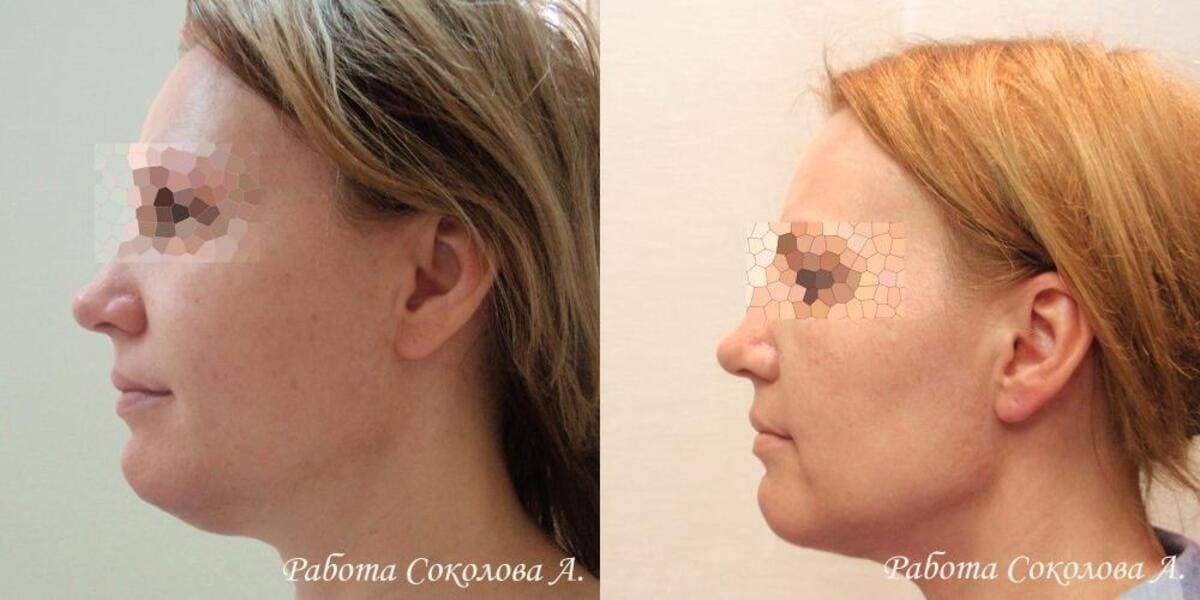 Подтяжка лица