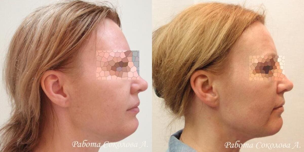 Подтяжка лица