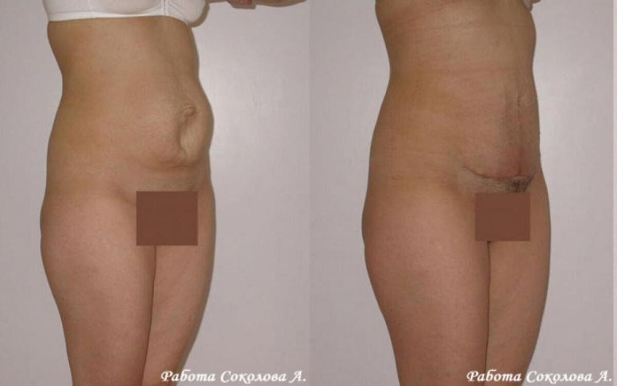 Абдоминопластика