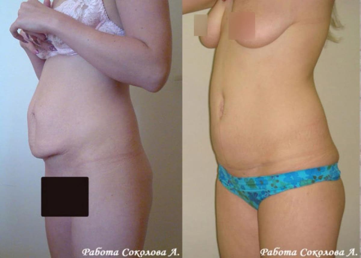 Абдоминопластика