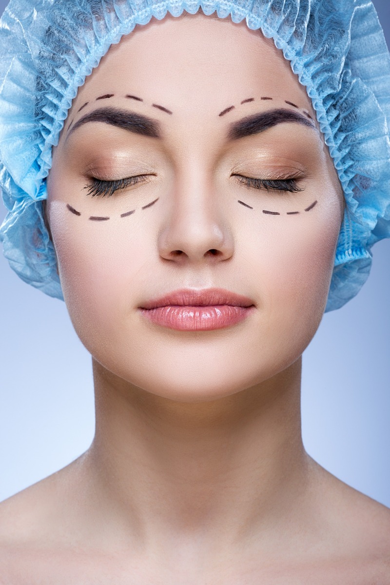 Плазменная блефаропластика век