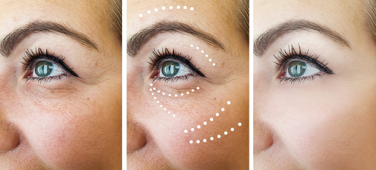 Повторная блефаропластика