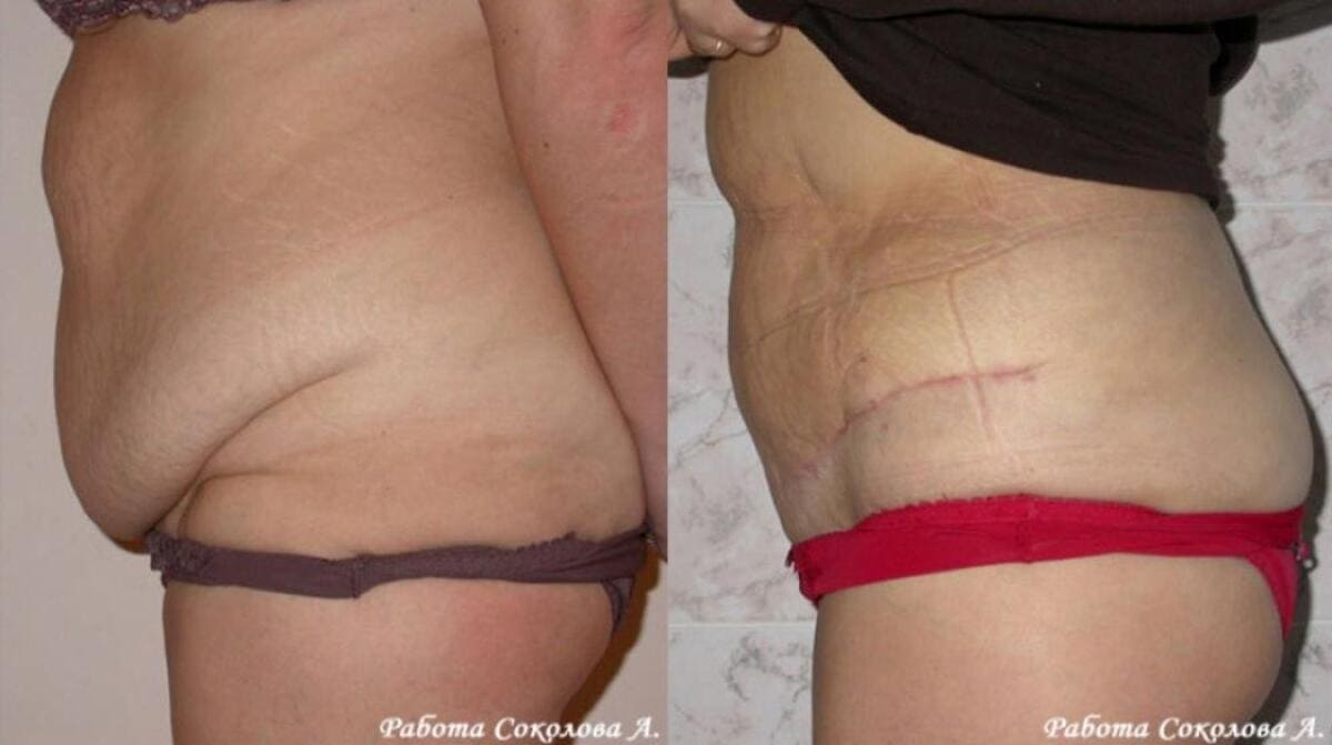 Абдоминопластика