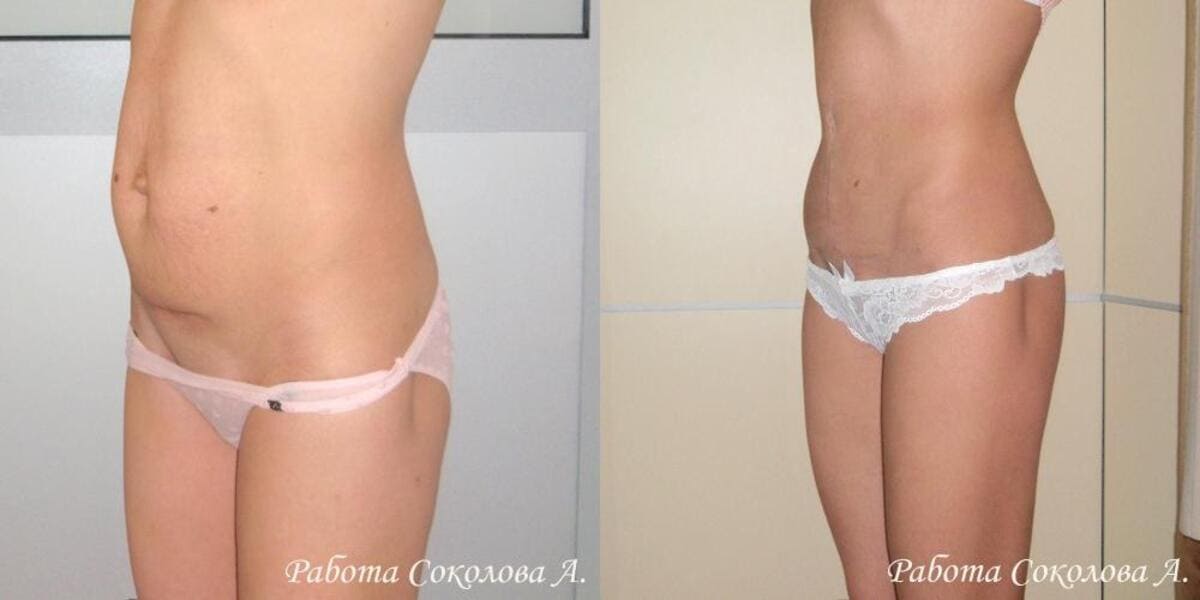 Абдоминопластика