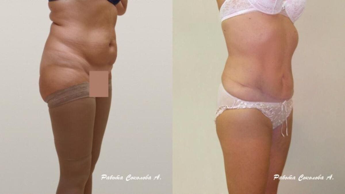 Абдоминопластика