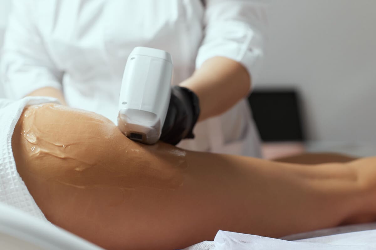 Липосакция