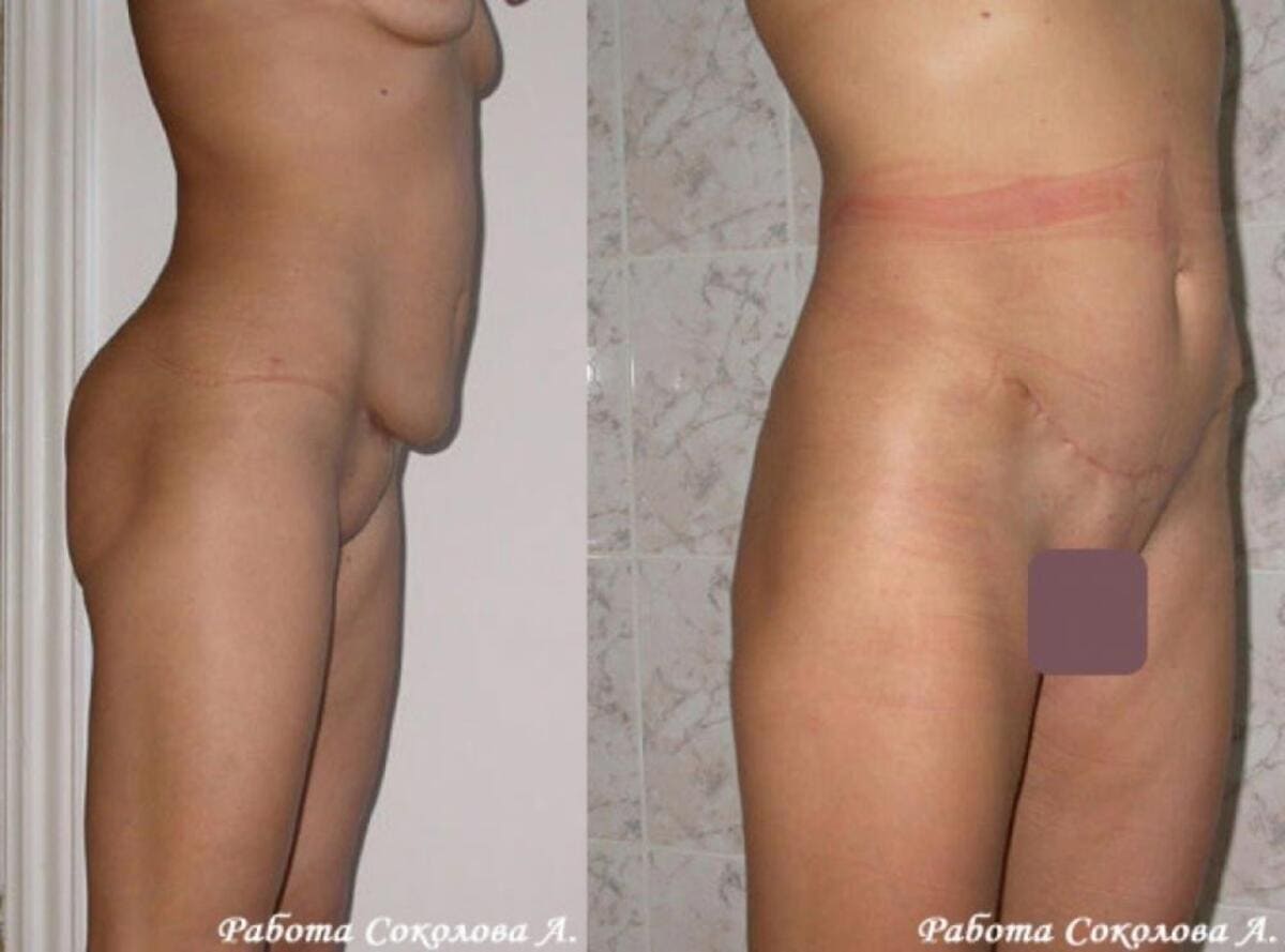 Осложнения абдоминопластики