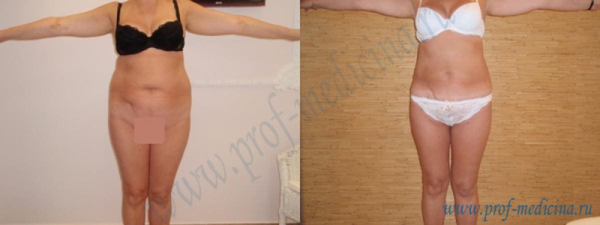 Шприцевая липосакция